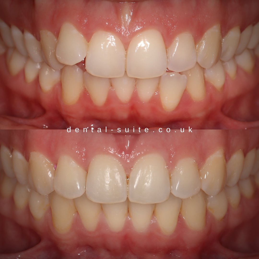 The Dental Suite on Twitter "Ceramic braces 🪄 In a little over half a