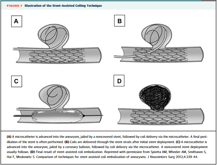 Zill_cardio's tweet photo. Stent Assisted Coiling Tech helps when covered stent placement is not possible due to 
1⃣Severe tortuosity,  
2⃣Calcification,or 
3⃣Fear of SB compromise https://t.co/JXZeqMfu0F