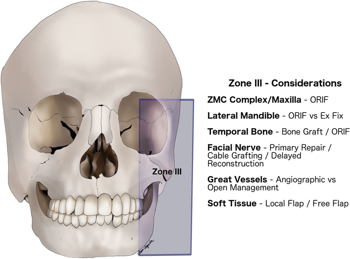 #BallisticFacialInjuries are rare, with most trauma centers reporting 1–20 cases annually. The aim of this #PRSGlobalOpen study was to review the authors experience with the application of #CraniofacialMicrosurgery in the management of #FacialGunshotWounds bit.ly/BallisticFacia…