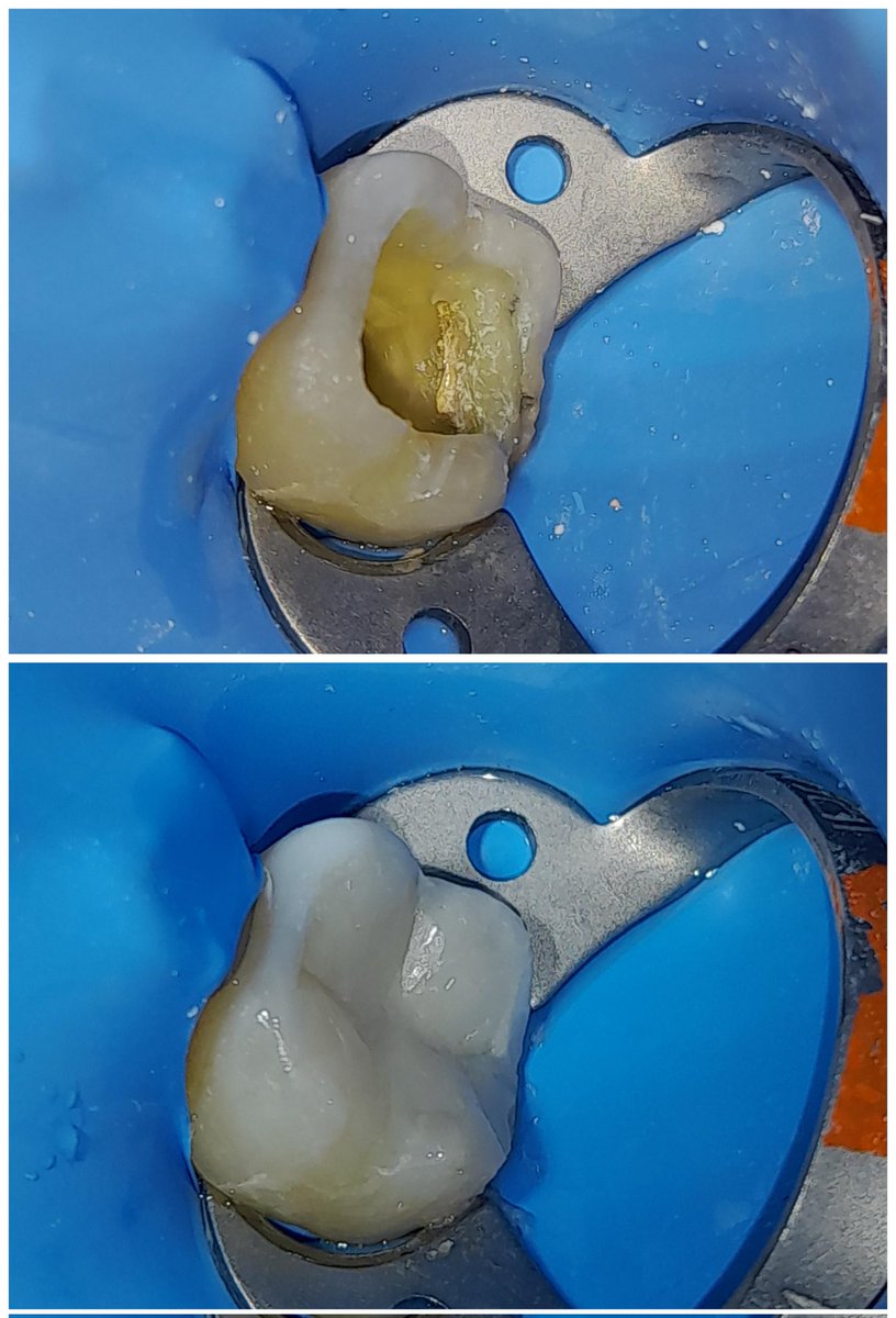 Dental24_7's tweet image. Con tratamientos más conservadores después de una endodoncia... #Prosthodontics #DirectComposite #EstheticDentistry #RestorativeDentistry #Dentista #Dental #Veneers #DentalVeneer #Dentistry #OdontologiaEstetica #Dentist #CosmeticDentistry #SmileMakeover #OralHealth #Odontología