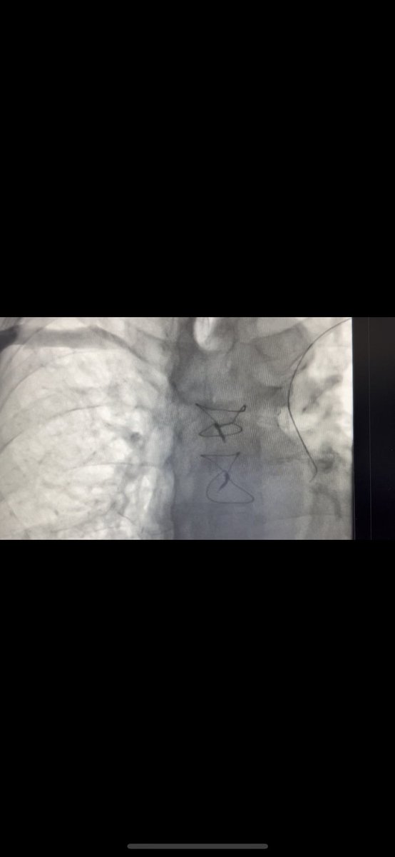 rfablation's tweet photo. Successful  #narrowQRS #MicraVR midseptal implant in permanent #AT, #completeAVB, #persistentleftsuperiorvenacava without superior access into #RA. Basal QRS 152 ms, paced 129 ms. @messapus @Hisdoc1 @DrRoderickTung https://t.co/1rLwpqbsUT