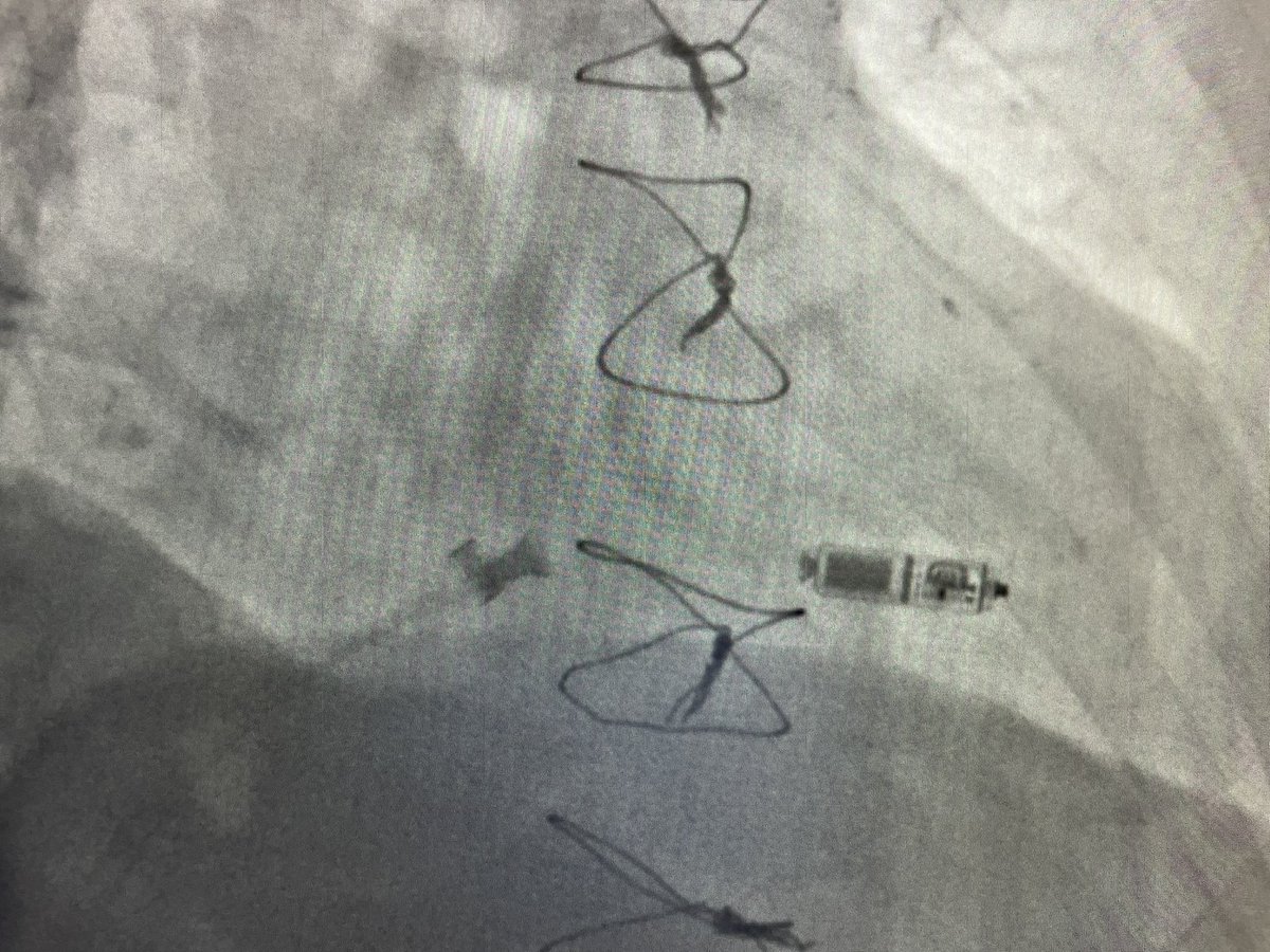 rfablation's tweet photo. Successful  #narrowQRS #MicraVR midseptal implant in permanent #AT, #completeAVB, #persistentleftsuperiorvenacava without superior access into #RA. Basal QRS 152 ms, paced 129 ms. @messapus @Hisdoc1 @DrRoderickTung https://t.co/1rLwpqbsUT