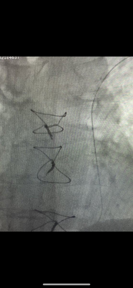 rfablation's tweet photo. Successful  #narrowQRS #MicraVR midseptal implant in permanent #AT, #completeAVB, #persistentleftsuperiorvenacava without superior access into #RA. Basal QRS 152 ms, paced 129 ms. @messapus @Hisdoc1 @DrRoderickTung https://t.co/1rLwpqbsUT