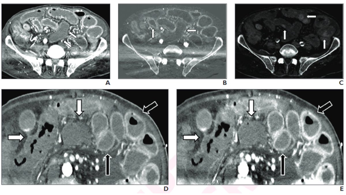 arosenkrantzmd's tweet image. New @AJR_Radiology Accepted Manuscript:

&quot;Imaging of Bowel Ischemia: An Update, From the AJR Special Series on Emergency Radiology&quot;

By Drs @MikeOlsonMD, @drashishcool, @ChrisWelleMD, @JeffFidlerMD, &amp;amp; team @MayoRadiology 

ajronline.org/doi/abs/10.221…