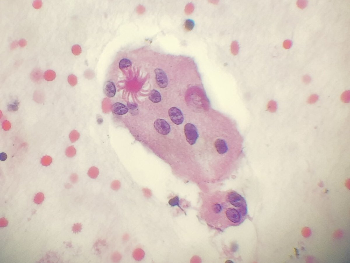 Arshi_Asma's tweet image. Giant cell with a cute asteroid body from a FNA cell block of a lymph node tissue in a 55yo female