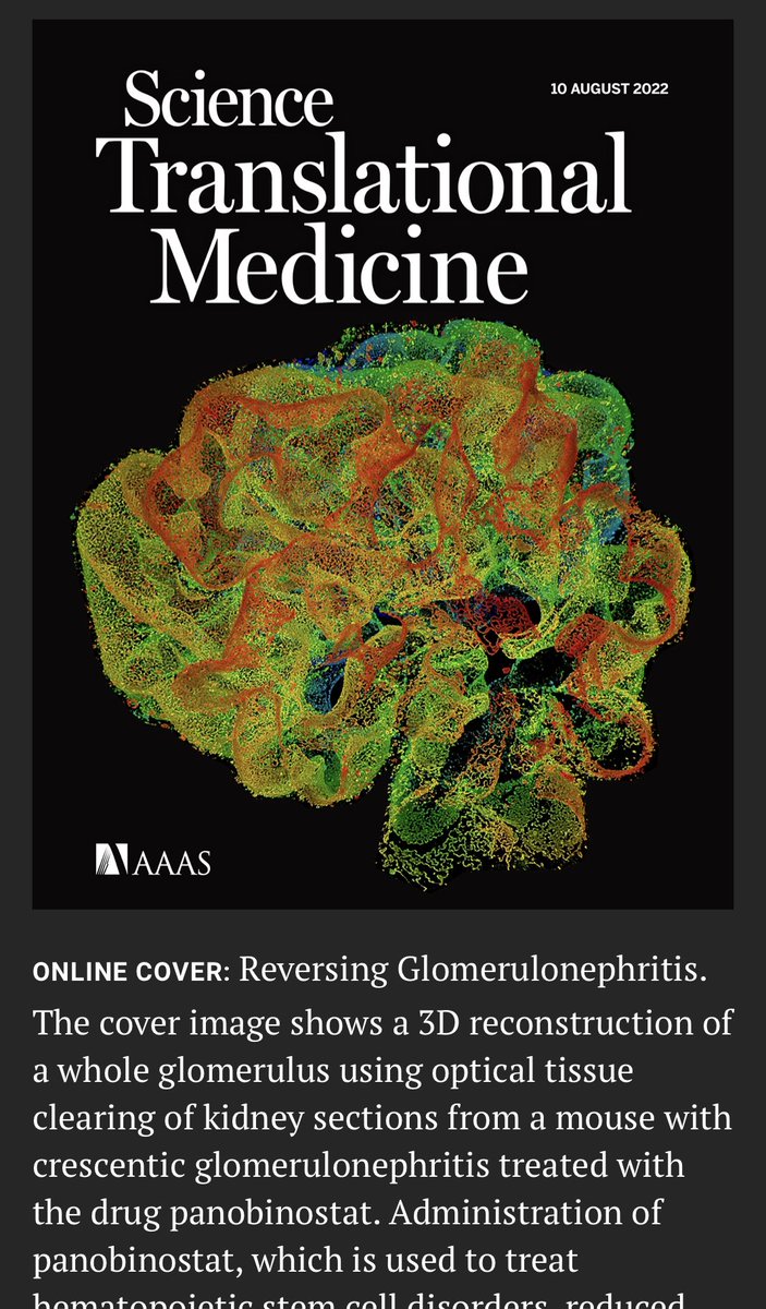 What is a crescent? An abnormal response of renal progenitors while trying to replace lost podocytes. Our new study shows reversal of crescents into podocytes is anyway possible and changes disease outcome science.org/doi/10.1126/sc…