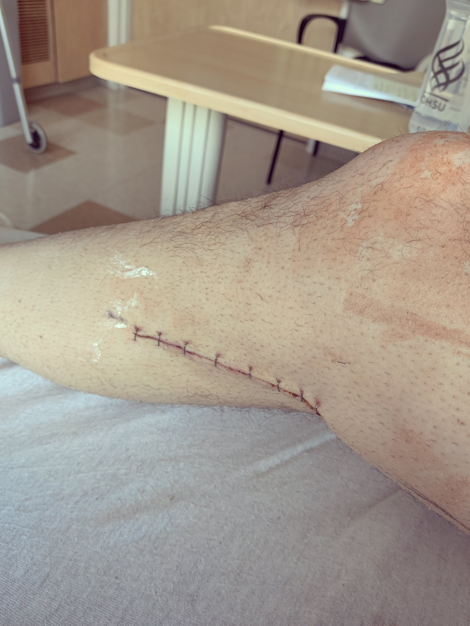 2 pic. Finally ready to post this since my surgery. I had blood clots and the surgeons at OHSU in Portland saved my legs and my life. I'd like to thank the cardiovascular team for what they did for me. Thank you, so much!! @ https://t.co/RprpR2T8Iz