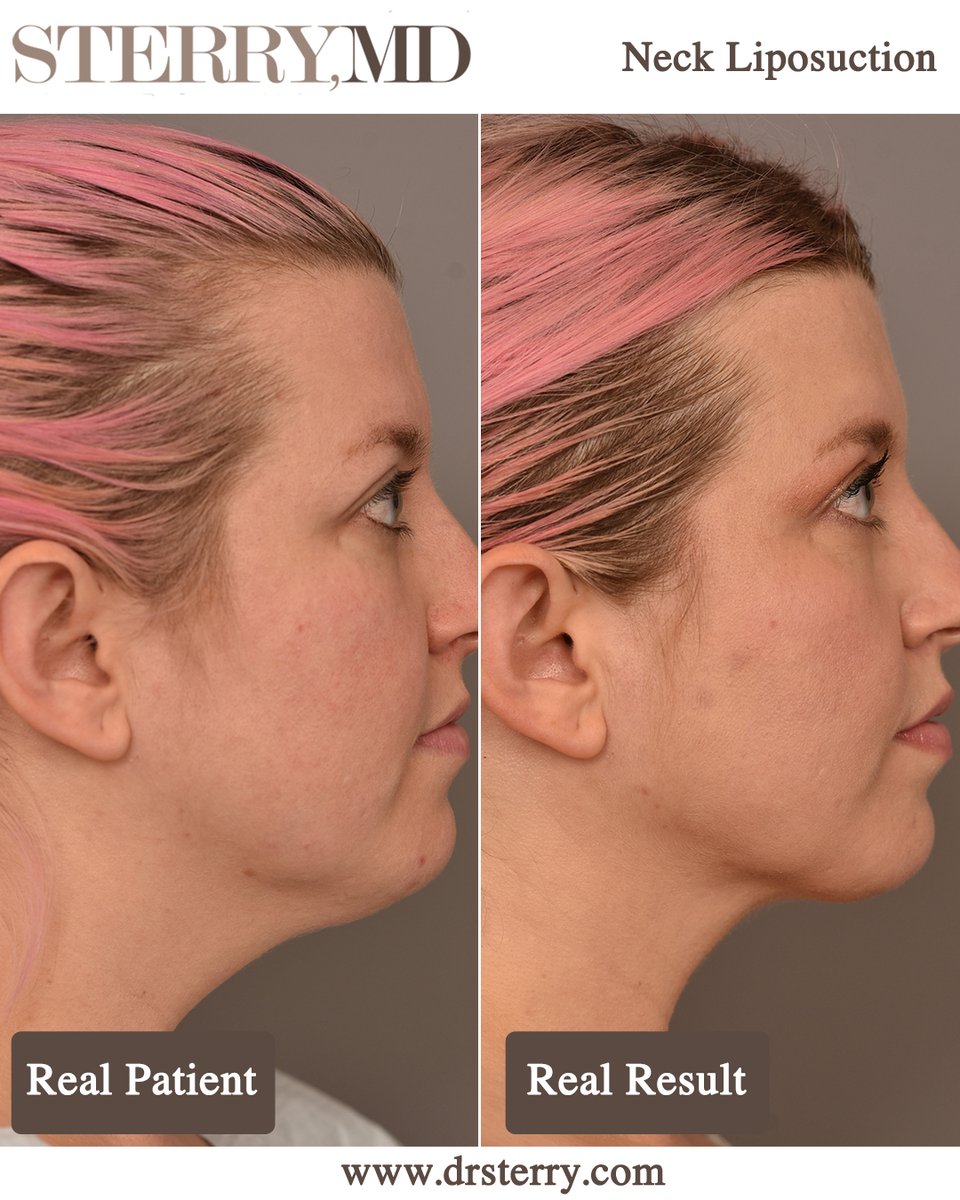 #ChinLiposuction is definitely the quickest and easiest way to shape your jawline 🎯

3 months later, she has a well defined neck and jawline with no visible scarring at all 😎

#doublechinremoval #doublechinreduction #lipochin
