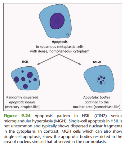 Miryousufkhan3's tweet photo. Glandular cells on pap are so exciting!!
source: Alrajjal A, Pansare V, Choudhury MS, Khan MY, Shidham VB. Squamous intraepithelial lesions of Uterine Cervix and Bethesda System. CytoJournal 2021;18:16. @ALRAJJALMD #cytopathology #pathology https://t.co/DzXY3kch0J