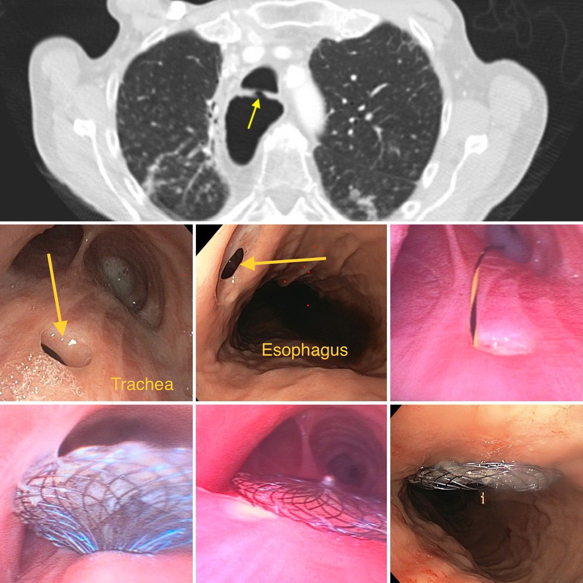 Plugging leaks. Tracheoesophageal (gastric) fistula 3 yr post esophagectomy. Closed with Amplatzer ASD closure device, deployed from esophagastric approach with bronchoscopic assistance. 
A great case with Cardiothoracic team from UT Health SA.
With @pulmo_dok and @UTHealthSA_CTS