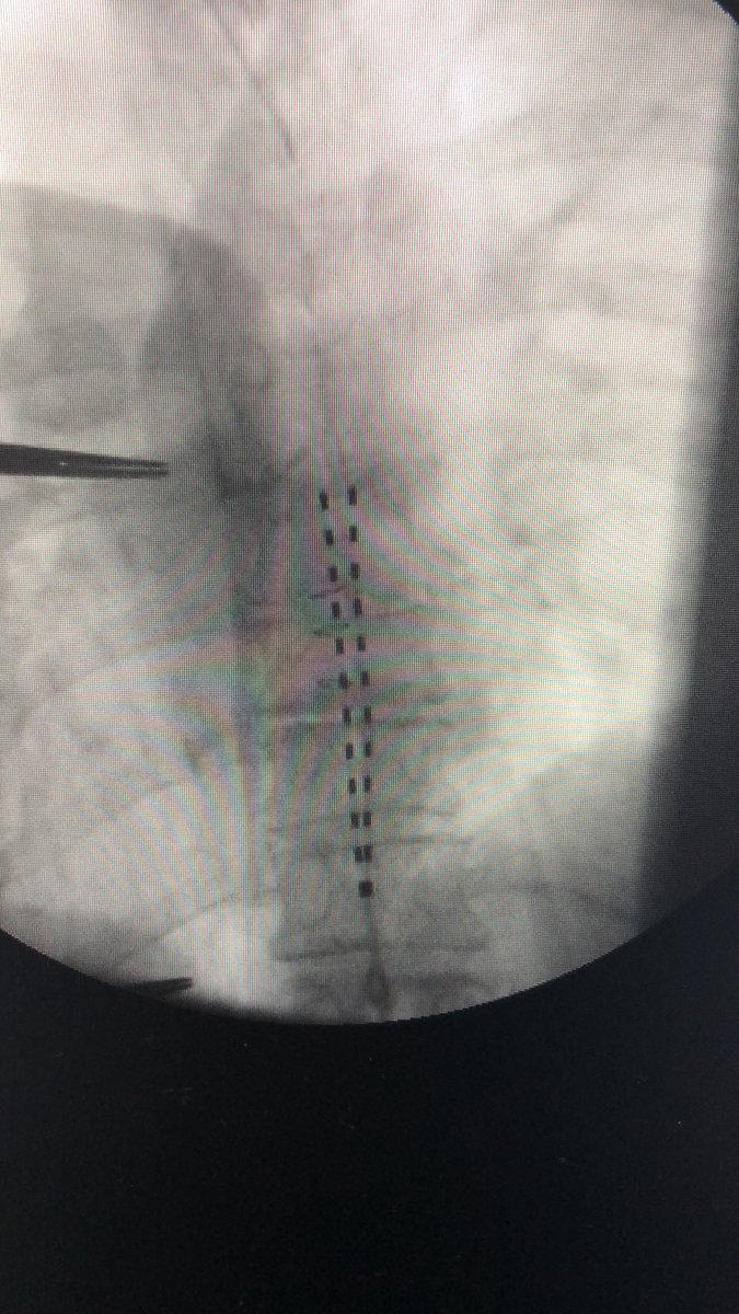 GLawsonSmith1's tweet photo. 1st week of fellowship/1st Implant with our new @UAMSPain Fellow Trevor Johnson @DoctorTrev_! With the OG @ErikaPetersenMD and me! #ECAP #Saludastudy @NANSRFS @ASRA_Society @ASPN_PainNeuro @DrJGoree @JarnaShahMD @jjacksonMD https://t.co/F1PO8Q1ZFv