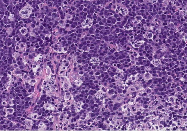 SibaElHussein's tweet photo. Example of high-grade B-cell lymphoma with 11q aberrations
🩸Remember, these were called "Burkitt-like lymphoma with 11q aberration" in the 4th edition of the WHO, now nomenclature updated to "high grade B-cell lymphoma with 11q aberration"
#hemepath #lymsm #PathTwitter https://t.co/cK4gArPcMm