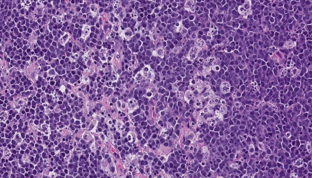SibaElHussein's tweet photo. Example of high-grade B-cell lymphoma with 11q aberrations
🩸Remember, these were called "Burkitt-like lymphoma with 11q aberration" in the 4th edition of the WHO, now nomenclature updated to "high grade B-cell lymphoma with 11q aberration"
#hemepath #lymsm #PathTwitter https://t.co/cK4gArPcMm