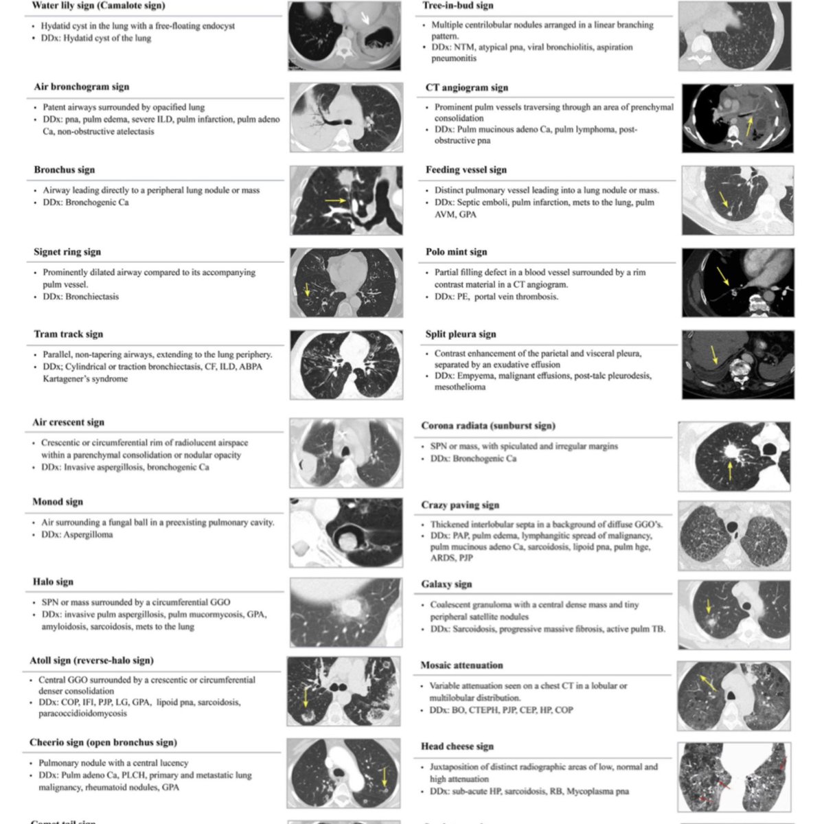 Incredible figure outlining pathological signs on CT chest 🫁 H/t @iwashyna @grepmeded #MedTwitter