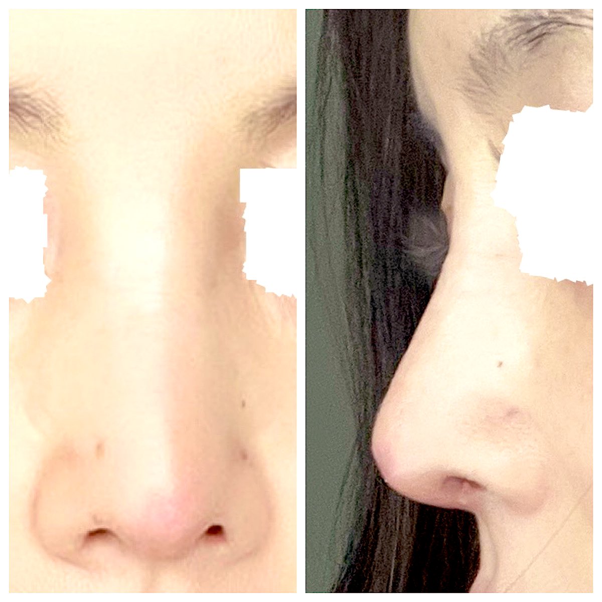 fujiko_seikei's tweet photo. 今日8/11で一ヶ月。今日で服薬全て終了です。
術後7日目（固定取れた7/18）と、術後一ヶ月の画像。術後7日目は医師の撮影したものをPCに取り込み、その画面を、スマホで撮影したものなので画像が荒いです。鼻先の赤味はだんだん取れてきました。 https://t.co/41XHcJZivc