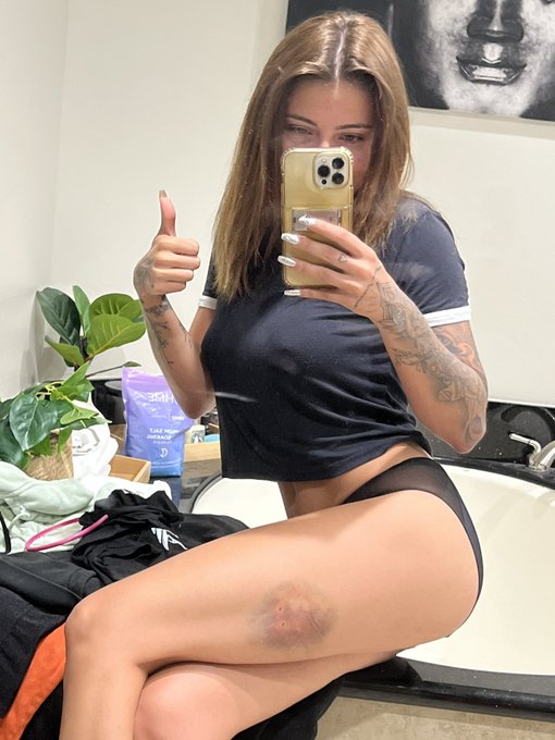 Bruise update: https://t.co/Kuj0NI0hA5