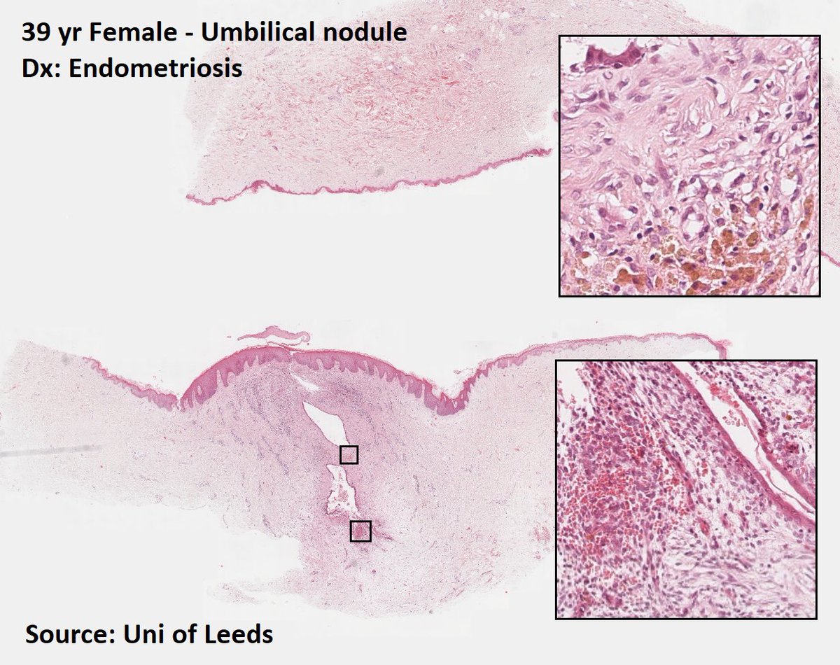 DrTravisBrown's tweet photo. Histology flash card
Endometriosis
~10% ♀
Fertility issues, dysmenorrhea, heavy periods, dyspareunia
Locations
-Ovary (67%)
-Ant/Post cul-de-sac
-Post broad lig
-Pouch of Douglas
-Bladder
Histo
Endometrial glands & stroma outside uterine cavity
Ep19 #ThisPathLife #podcast https://t.co/Z9TDZtINON