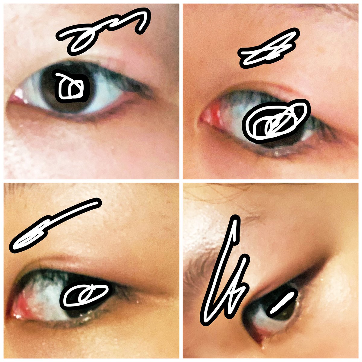 dietdietsur's tweet photo. 水の森埋没取れた https://t.co/AT0FbknLXx