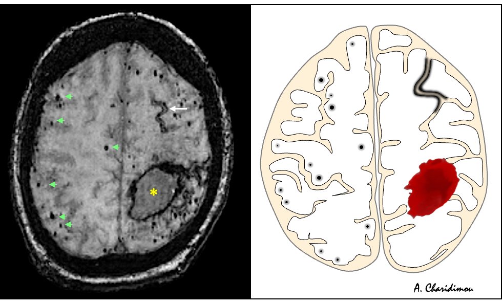 🩸🧠Hemorrhagic MRI manifestations of CAA
(Cerebral Amyloid Angiopathy)

1) Lobar intracerebral hemorrhage 🩸
2) Lobar cerebral microbleeds ⚫️
3) Cortical superficial siderosis 🎢 

#neurotwitter #radres #NeuroTwitter #NeuroRad #Neurology #Neurosurgery #RadEd #stroke #Alzheimers