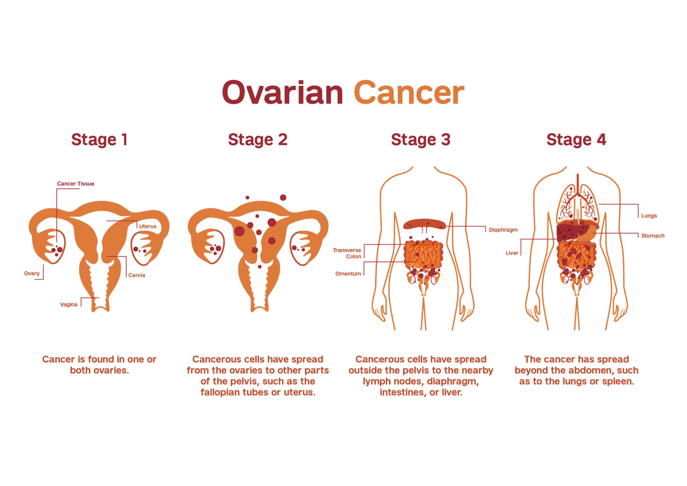 Ovarios inflamados sintomas