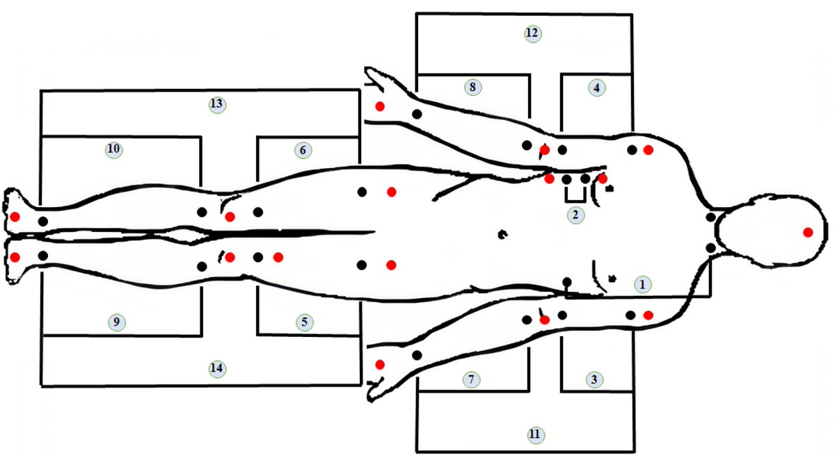 Sensors_MDPI's tweet image. Multi-Channel Bioimpedance System for Detecting Vascular Tone in Human Limbs: An Approach
mdpi.com/1424-8220/22/1…
#bioimpedance #graphicalinterface #signalprocessing