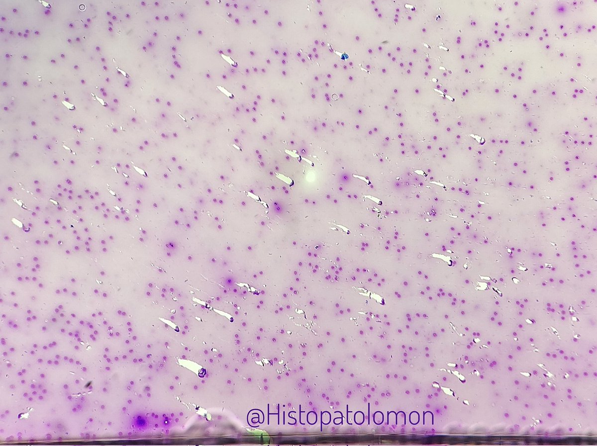 Histopatolomon's tweet photo. Happy meteor night, the Perseids (tears of Saint Lawrence). Thyroid FNA https://t.co/1CqHDDAUpB