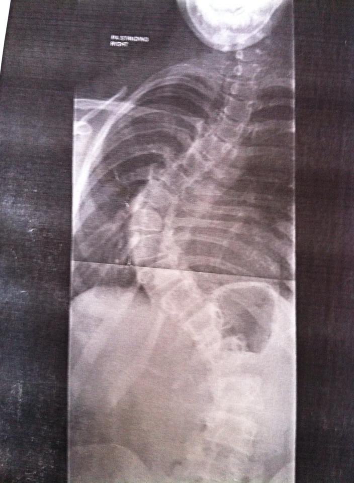 sophysio_kemp's tweet photo. Happy 11 years bionic to me #itwillnevergetold https://t.co/gIZsdgD2H9