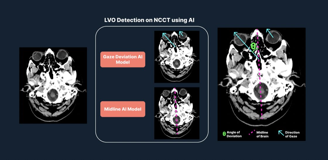 What's in our latest #neurotwitter #newsletter: ✅Abstract presentation at @SNISinfo #SNIS2022 about our #ArtificialIntelligence algorithm ✅The algorithm has a sensitivity = 80.8% & specificity = 80.1%, to detect LVO using gaze deviation Intrigued? Read rb.gy/g21qmy