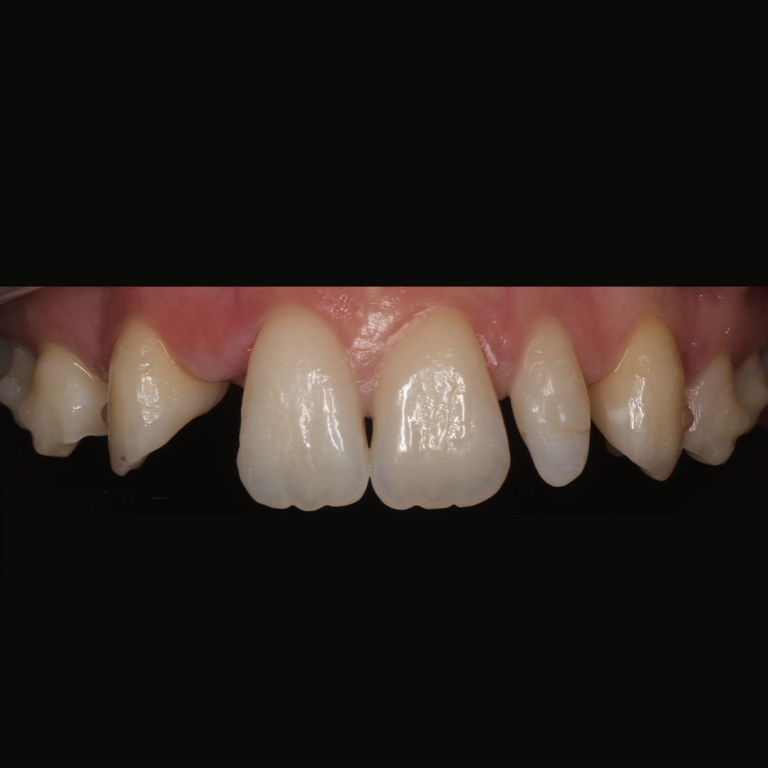 SeapointClinic's tweet photo. Check out this incredible #smile #makeover!

Dr. Jim Griffin and Dr. Flannery were able to give Ava her smile back thanks to specialist treatment. Our #hitech scanning system monitored Ava's smile throughout, ensuring she got her #dream smile!

https://t.co/4QRSqlL9jC https://t.co/Ym2AMxxtsN