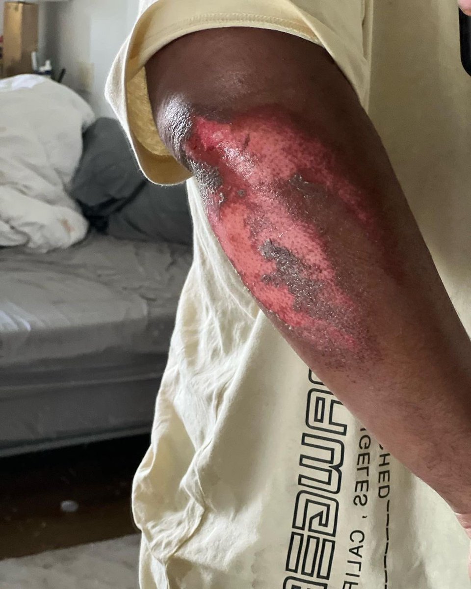 TheFlagGang's tweet photo. @GordoSZN (formerly Carnage) shares pictured of himself after an accident, stating he “almost died today”. https://t.co/TyLjV2sQWp