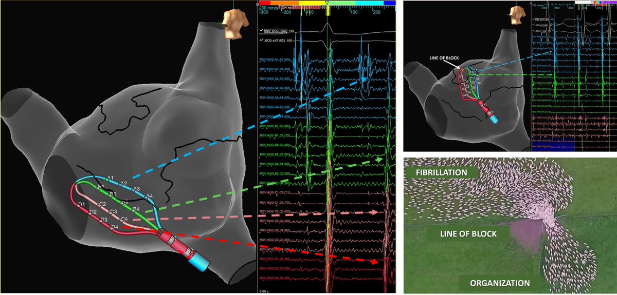 Lines of block from regions of scar organize AF into flutter-like bystander rhythm in the RA. Note the decreasing complexity as the splines approach the funnel point. Interesting observation to apply to our AF interpretation. #AbbottAF #HDGrid #MidAmericaEP @AbbottCardio