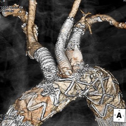 UMassVascSurg tweet picture