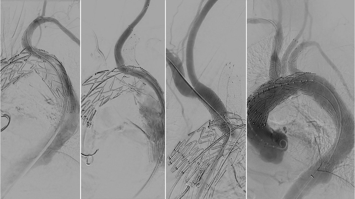 First implantation of a 3 retrograde branch aortic arch device using only groin access. Grateful to <a href="/CookMedical/">Cook Medical</a> for the opportunity to collaborate and innovate.