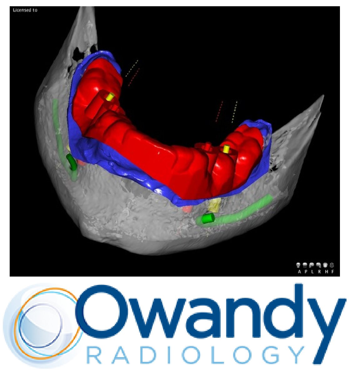 MikeVentriello's tweet photo. @OwandyR the world-leading digital radiography company is now using #AI to guide the placement of implants from over 100 manufactuers. Read more in @jflucke's blog: https://t.co/x2vtxVE3rp
#ArtificialIntelligence #DentalImplants #ImplantLibraries https://t.co/Srx3yTT2lJ