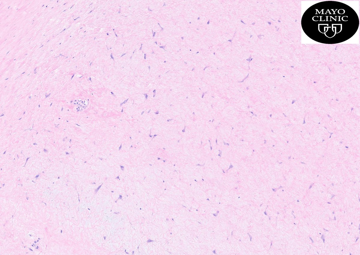 🔬 Foot mass 👣 🔬 Your Diagnosis? <a href="/mayocliniclabs/">Mayo Clinic Labs</a> <a href="/MayoClinicPath/">Mayo Clinic Pathology</a> <a href="/JenniferBoland7/">Jennifer Boland, MD</a> <a href="/GaryKeeneyMD/">Gary L. Keeney, M.D.</a> @johncheville <a href="/DrAldehyde/">Woo Cheal Cho, MD</a> <a href="/RawiaMo57385655/">Rawia Mohamed</a> <a href="/kabeerkshah/">Kabeer Shah, DO</a> <a href="/pembeoltulu/">Pembe Oltulu, MD</a> <a href="/JMGardnerMD/">Jerad Gardner, MD</a> <a href="/LizMontgomeryMD/">Elizabeth Montgomery, MD</a> <a href="/kriyer68/">Kalyani Bambal</a> <a href="/GeronimoJrLapac/">Gerônimo Jr.</a> <a href="/PathBst/">BST Path Education</a> <a href="/NRiddleMD/">Nicole D. Riddle, MD, MSHI, FCAP (she/her)</a> <a href="/JMcMahonG/">John Gross, MD</a> <a href="/Chucktowndoc/">Frank Ingram, MD</a>