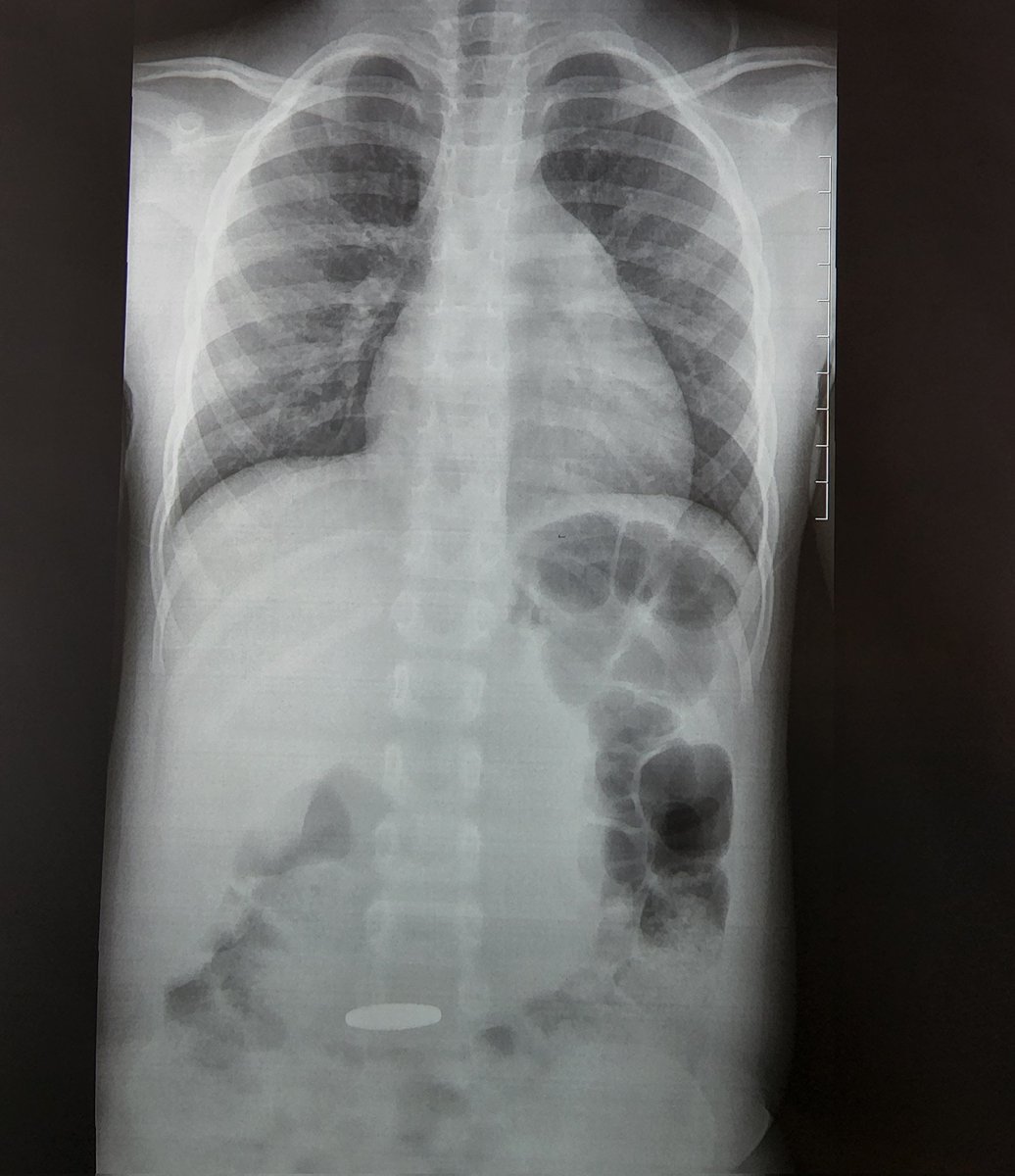 4yr old child. What can you see on the x-ray? How will you manage this child? #MedTwitter #RxTwitter