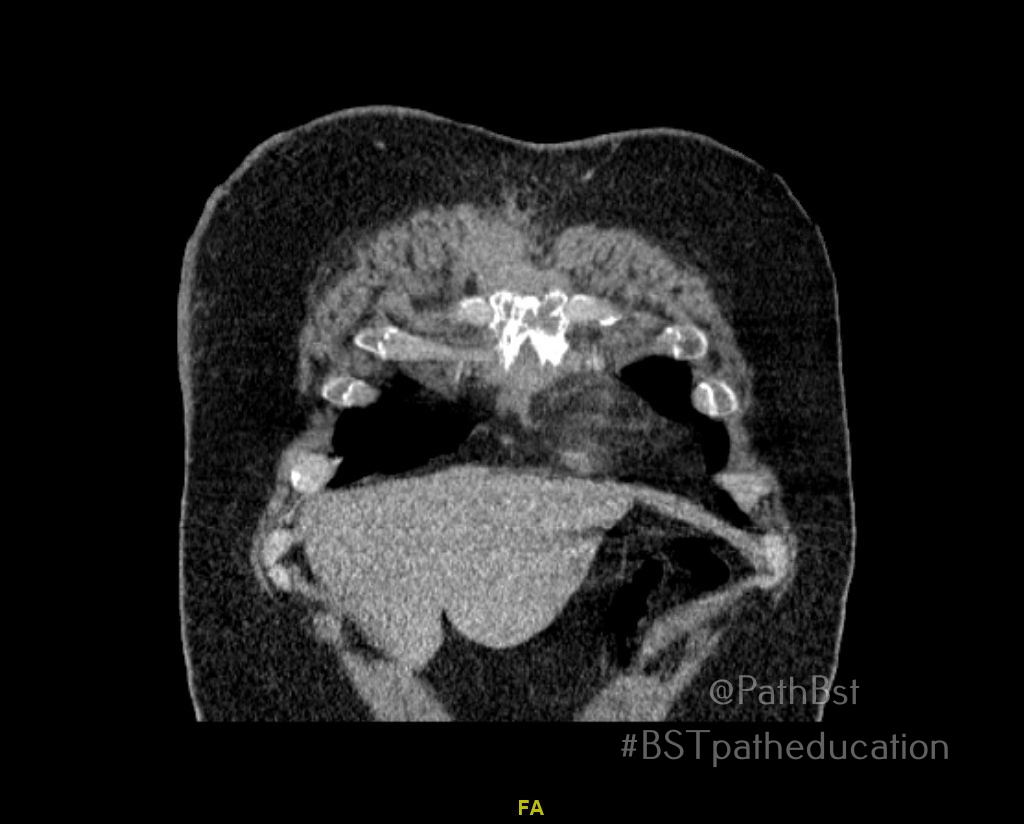 PathBst's tweet image. Another bread and butter case with fun #radpathcorrelation. Young adult with destructive sternal lesion and mediastinal lymphadenopathy. What immunostains do you want and what stage is this?
#BSTpatheducation