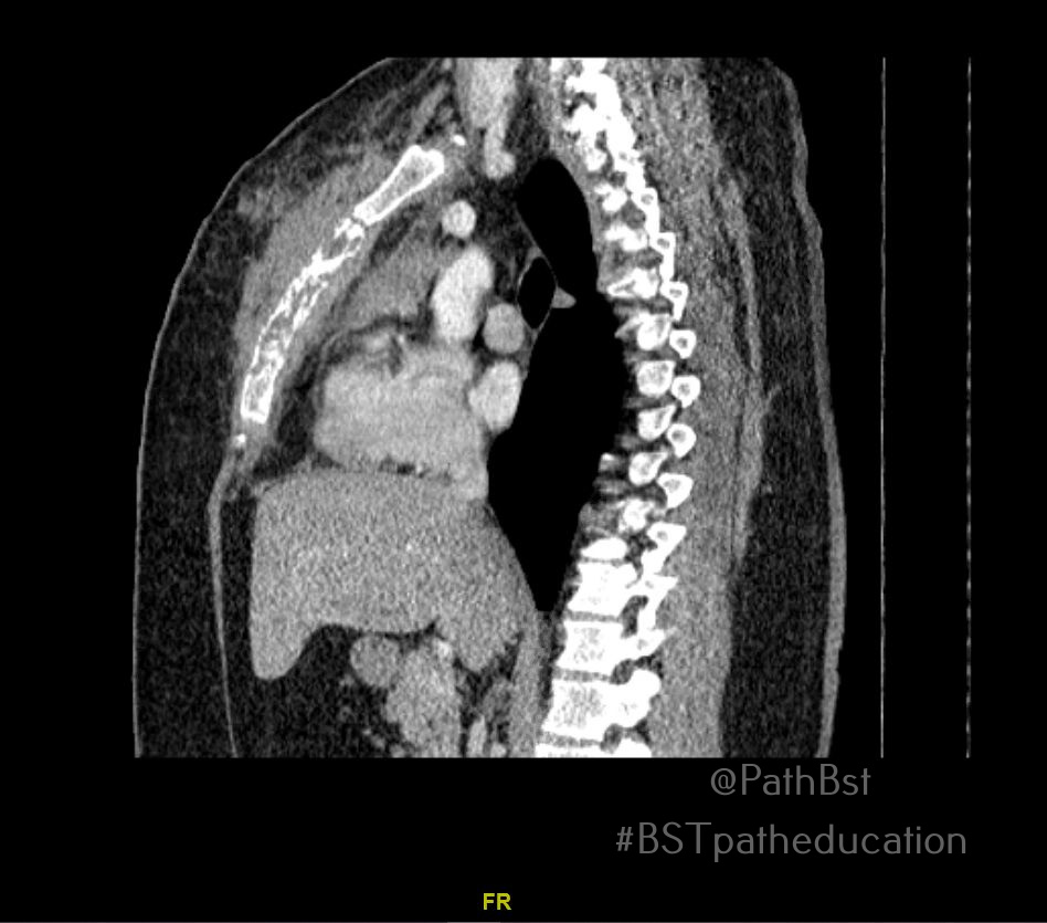 PathBst's tweet image. Another bread and butter case with fun #radpathcorrelation. Young adult with destructive sternal lesion and mediastinal lymphadenopathy. What immunostains do you want and what stage is this?
#BSTpatheducation