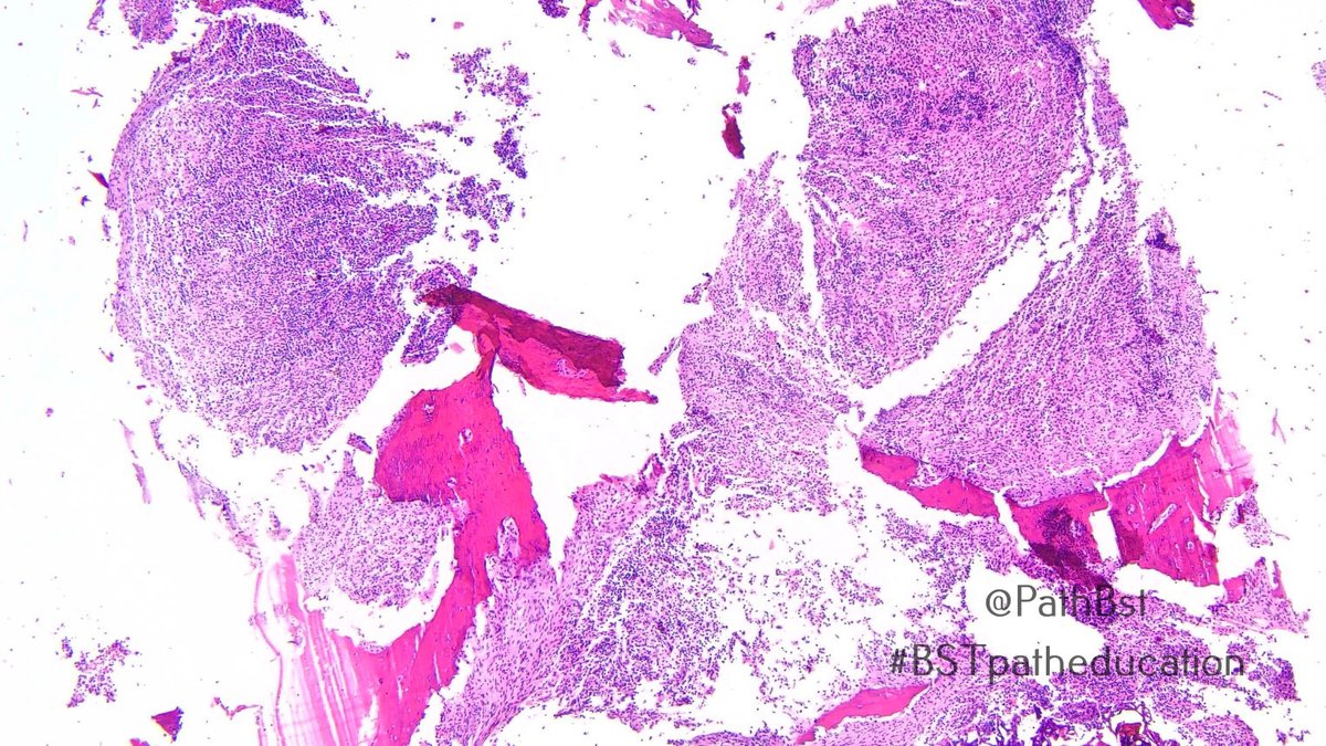 PathBst's tweet image. Another bread and butter case with fun #radpathcorrelation. Young adult with destructive sternal lesion and mediastinal lymphadenopathy. What immunostains do you want and what stage is this?
#BSTpatheducation