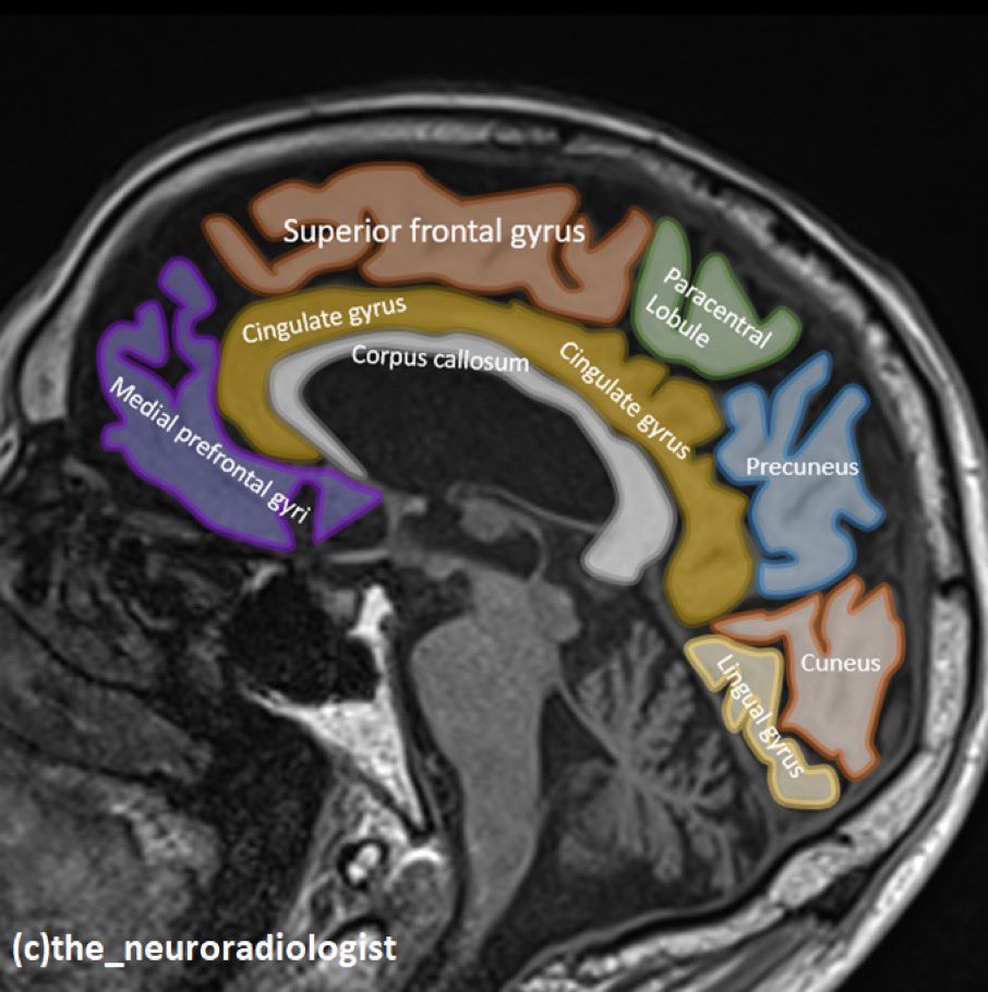 Brain MRI anatomy made easy from <a href="/theneuroradguy/">The Neuroradiologist</a>