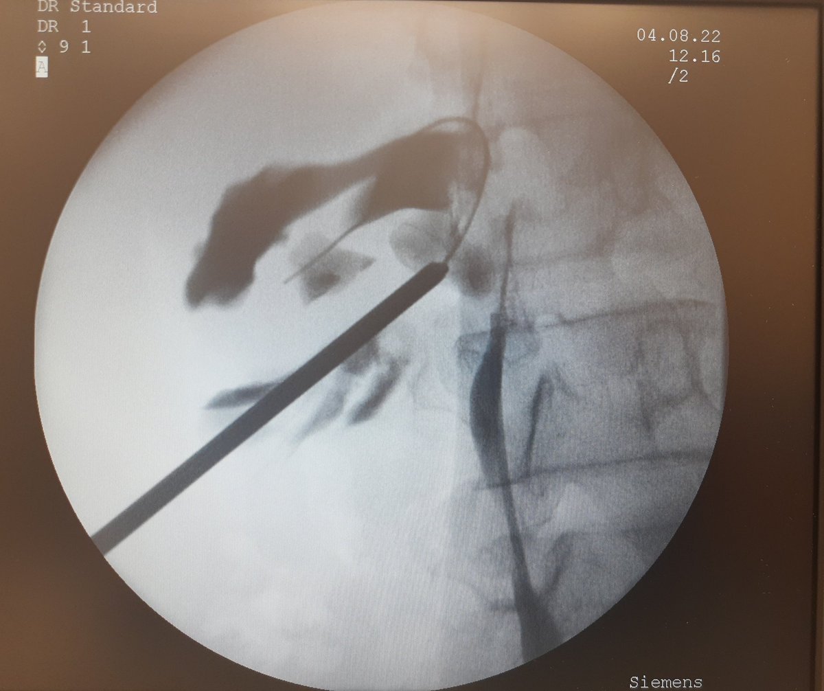Diego Santillan (@diesantillan) on Twitter photo #endourology #urosome #pcnl
When the ⬇️LOWER pole becomes the ↗️ MEDIAL one..
📝 Ultra thin patients are not that easy (<50kgs)❗
<a href="/MSGONZALEZURO/">Mariano Sebastian Gonzalez</a> <a href="/CristalloCh/">Christian Cristallo</a>
<a href="/A_CabreraURO/">Andres Cabrera</a> <a href="/UroHIBA/">UroHIBA</a> <a href="/FrancoThomasOK/">Franco Thomas</a> #endourology #urosome #pcnl
When the ⬇️LOWER pole becomes the ↗️ MEDIAL one..
📝 Ultra thin patients are not that easy (<50kgs)❗
<a href="/MSGONZALEZURO/">Mariano Sebastian Gonzalez</a> <a href="/CristalloCh/">Christian Cristallo</a>
<a href="/A_CabreraURO/">Andres Cabrera</a> <a href="/UroHIBA/">UroHIBA</a> <a href="/FrancoThomasOK/">Franco Thomas</a>