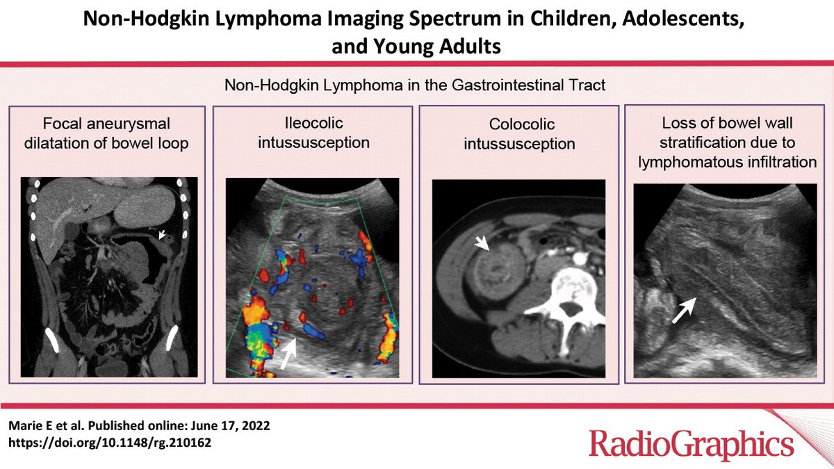 Great refresh of what #lymphoma in #pediatric patients and younger patients may present with on #imaging via Radiographics.
