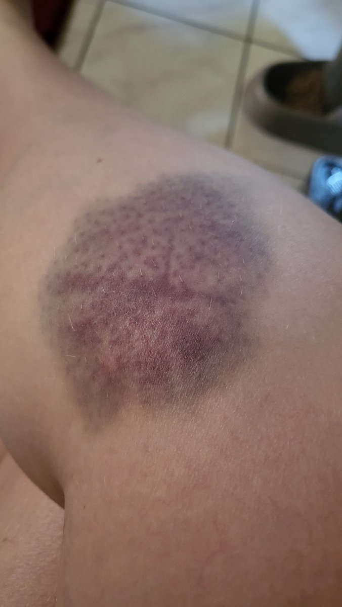 Aenah_'s tweet photo. Il y a des gens qui se font mal en faisant une activité sportive, manuelle etc. et y a moi, qui se fait mal en essayant de faire partir une guêpe de chez soit.
J'ai mal et elle est encore là 😭 https://t.co/tlAcEPw5et