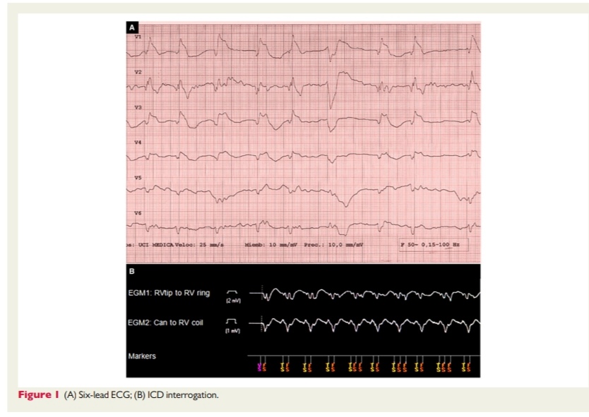 1/2 It's #ESCCongress month🙂
Warm up with the new #SpotTheDiagnosis challenge from #EHJACVC.

Check out the case and answer the question 👇
doi.org/10.1093/ehjacc…

#EHJACVC @EHJACVCEiC @drmilicaa @krychtiukmd @mrubini @umityasarsinan1 #ACVC_ESC