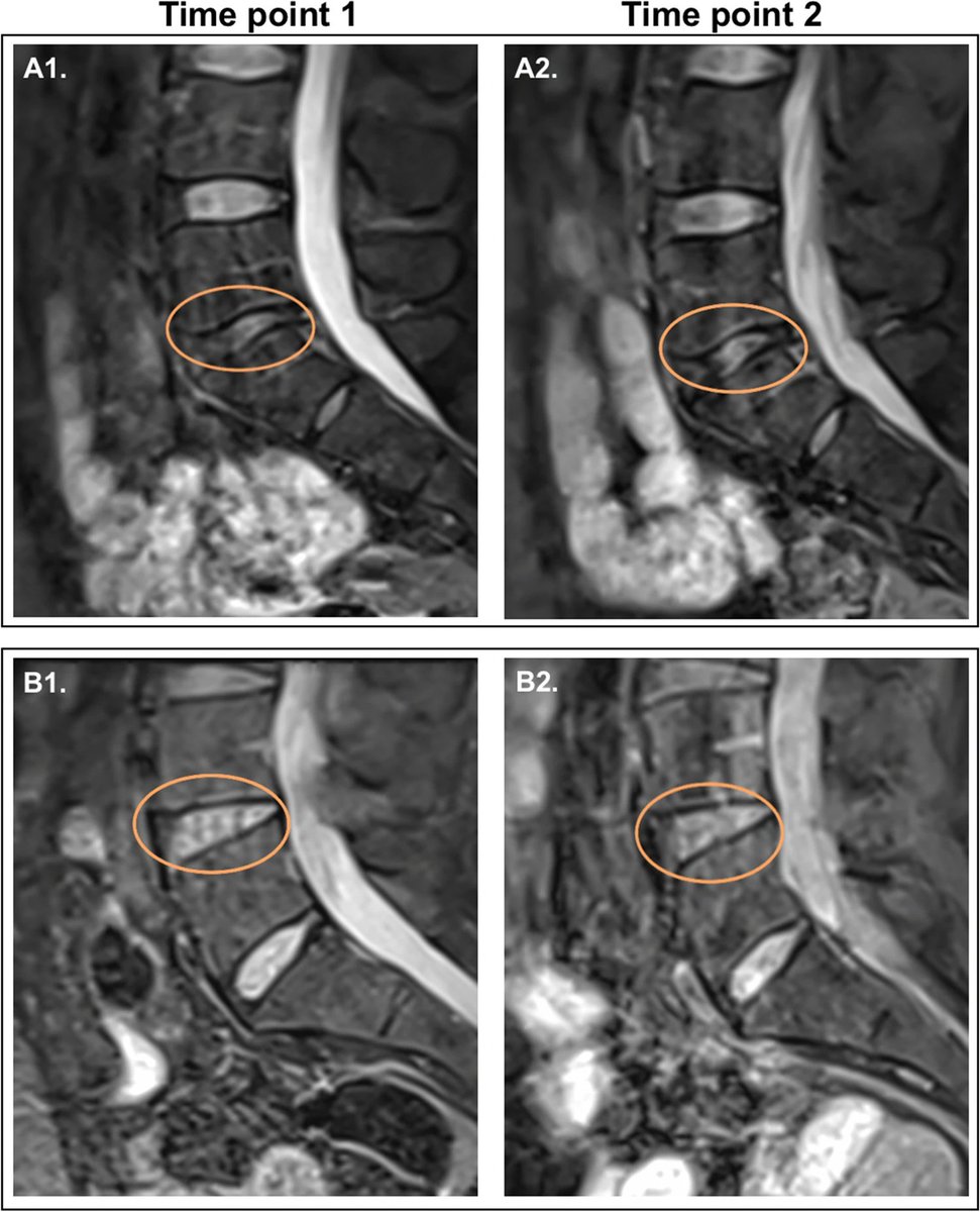 Running 500 miles over 4 months plus a marathon for the first time had no adverse effects on the lumbar spine, even when early degenerative changes were present. 

🏃‍♂️🏃🏃‍♀️

link.springer.com/article/10.100…