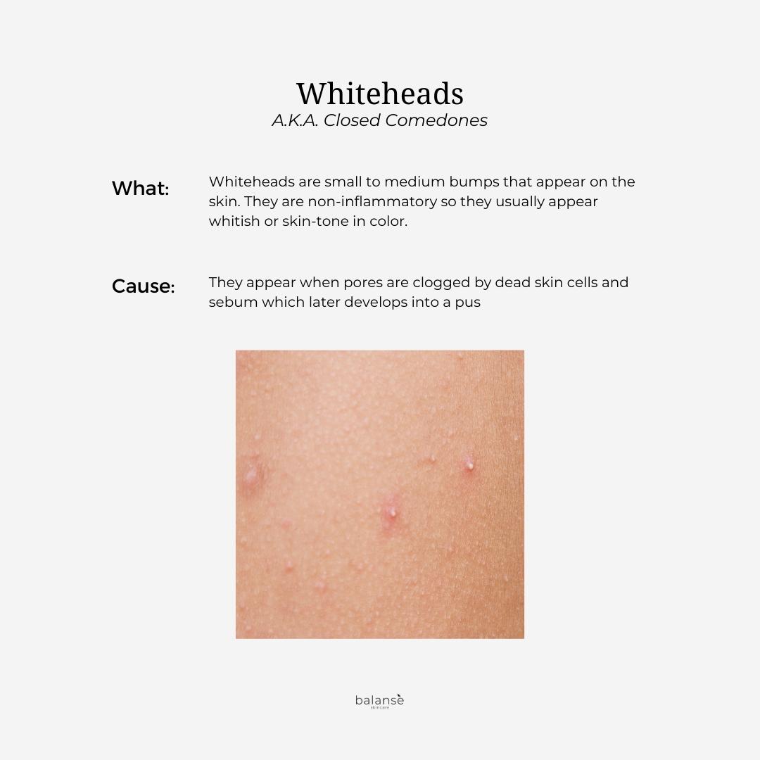 BalansePh's tweet photo. What are the types of acne?

For the #bestskincarefor acne visit https://t.co/26BMvVdyp9

#balanse #balansè #balanseskincare #acne #acneskincare #acnetreatment #acenproblems #acnefree https://t.co/BkA7cd3O2e