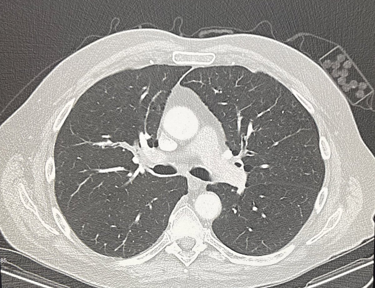 DrFranckClarot's tweet image. Quand la cause est immédiatement visible au scanner 🤔🤓