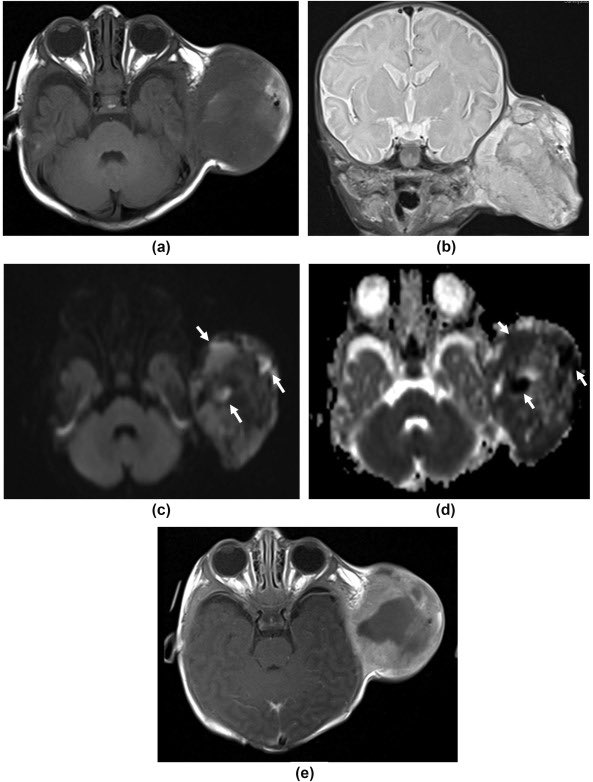 ClinRadiology's tweet photo. Read this brilliant review next, complete with incredible illustrative cases 👇👇👇
Imaging characteristics of infantile fibrosarcoma
#PaedRad @RCRadiologists @ClinOncology @ELS_Radiology @SaEleti @GreatOrmondSt 
https://t.co/OPiOaZWYZM https://t.co/XgiRkpNG5u
