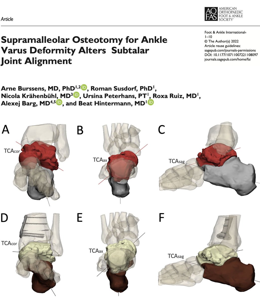 Arne Burssens (@a_burssens) on Twitter photo For so long, alignment of the subtalar joint has been obscured by superposition on #xrays! Thanks to novel #weightbearingCT images and #semiautomated #3D measurements we could reveal its interaction with supramalleolar osteotomies in our latest study published in <a href="/AOFAS_Journals/">AOFAS_Journals</a> For so long, alignment of the subtalar joint has been obscured by superposition on #xrays! Thanks to novel #weightbearingCT images and #semiautomated #3D measurements we could reveal its interaction with supramalleolar osteotomies in our latest study published in <a href="/AOFAS_Journals/">AOFAS_Journals</a>