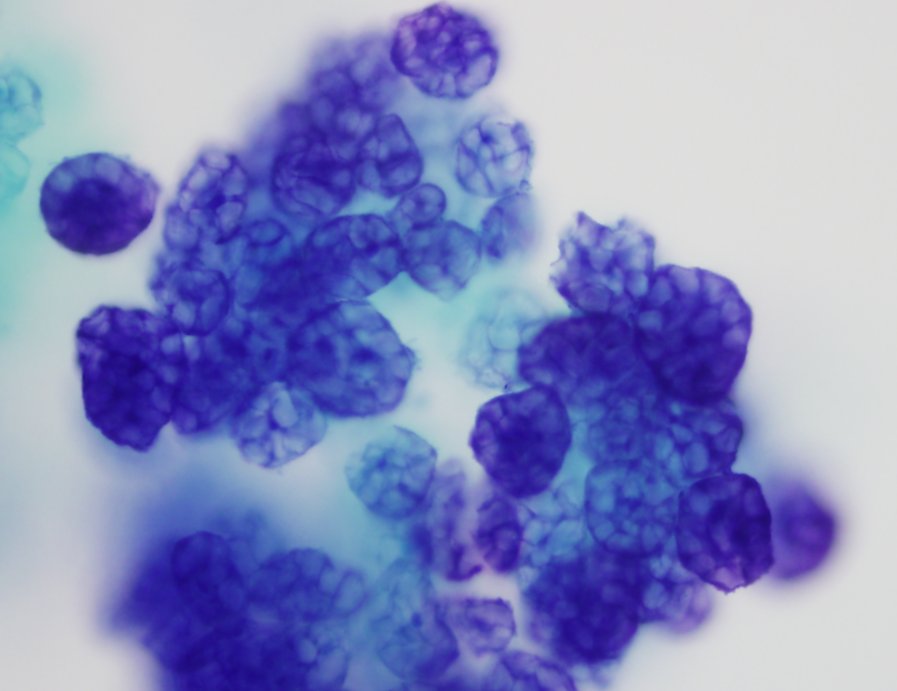 shrockmd's tweet photo. Pinto bean cytology smear; DiffQuik rapid assessment :)
#PathTwitter #cytopath #foodphotography https://t.co/IqcKpWleQU